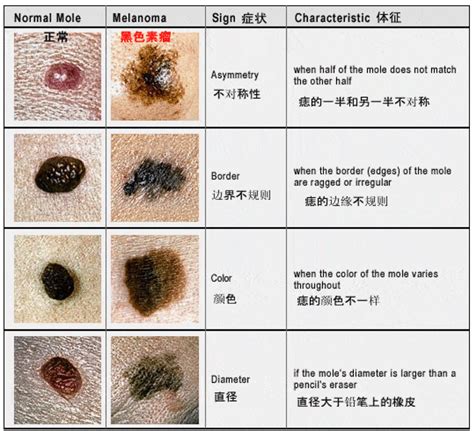 多痣的人|身上7种痣一定会癌变！